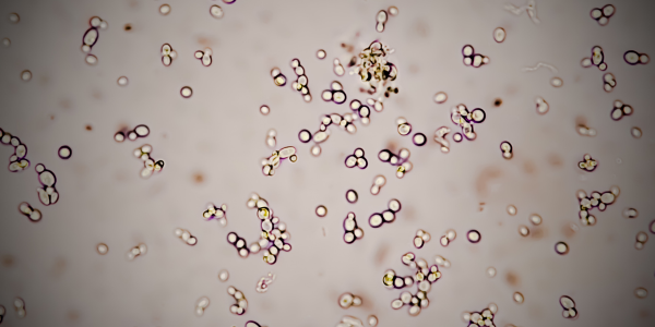 LA CANDIDIASIS: Síntomas, Contagio, Prevención y Tratamiento. 